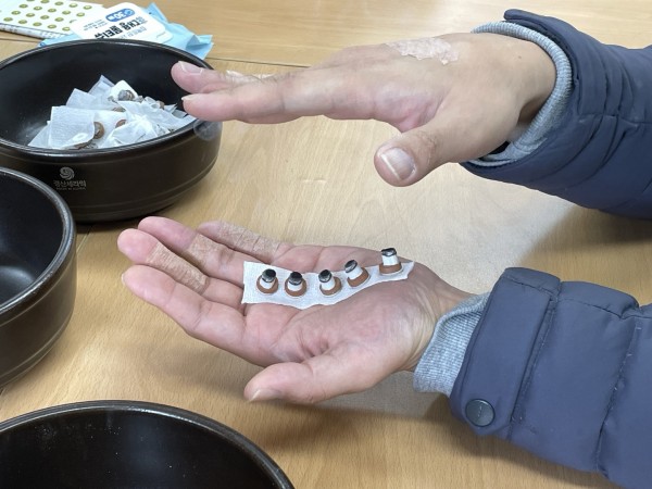 쑥뜸 받고 있는 모습